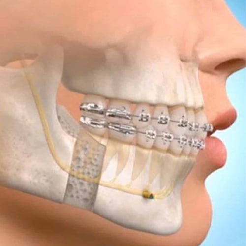MAXILLOFACIAL