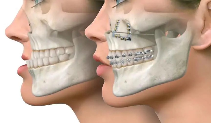 img-jaw_surgery-18