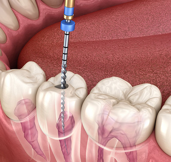 root-canal-2 root-canal-2